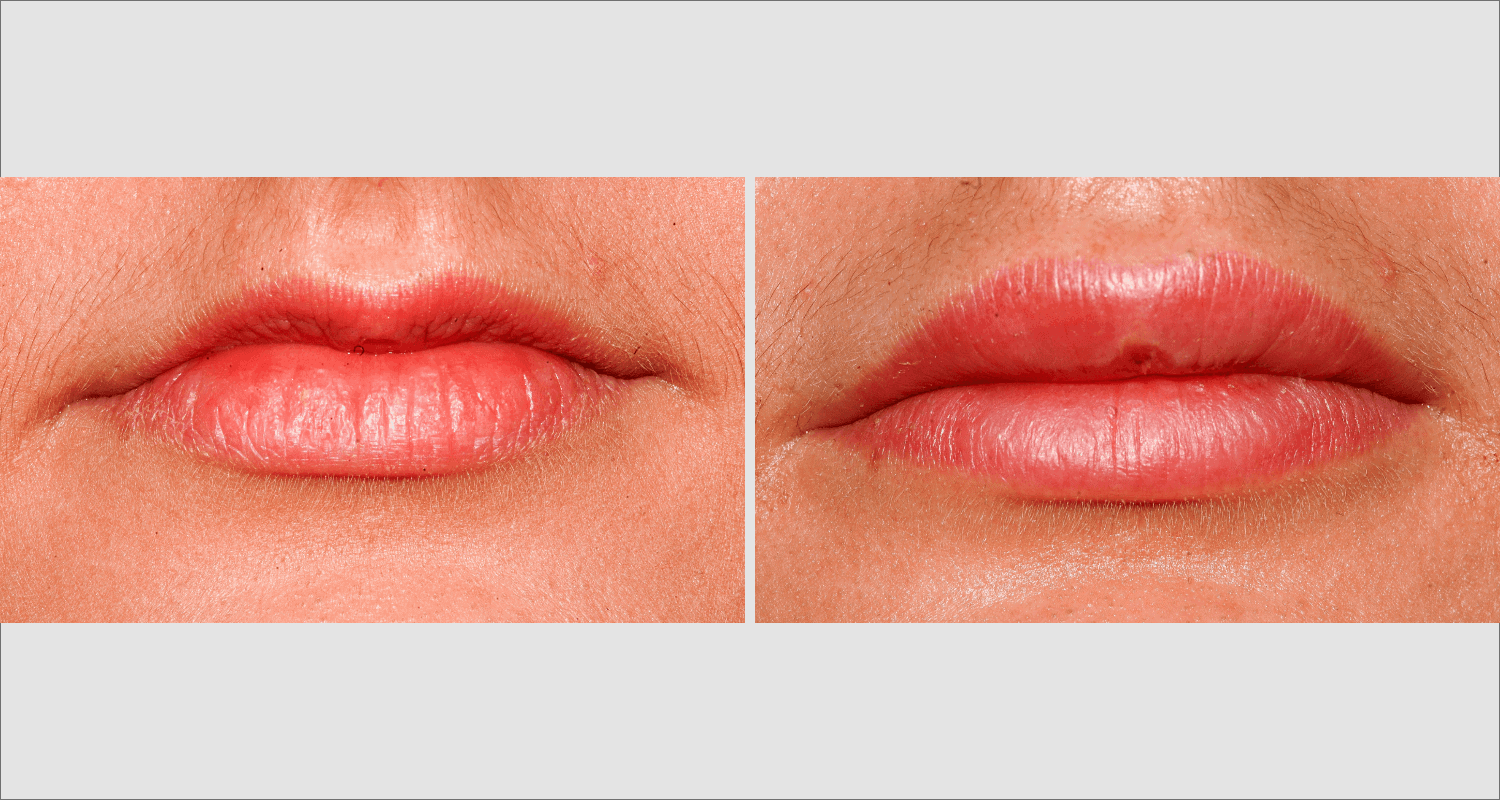 Vorher/Nachher Ergebnis: Eigenfett Lippen