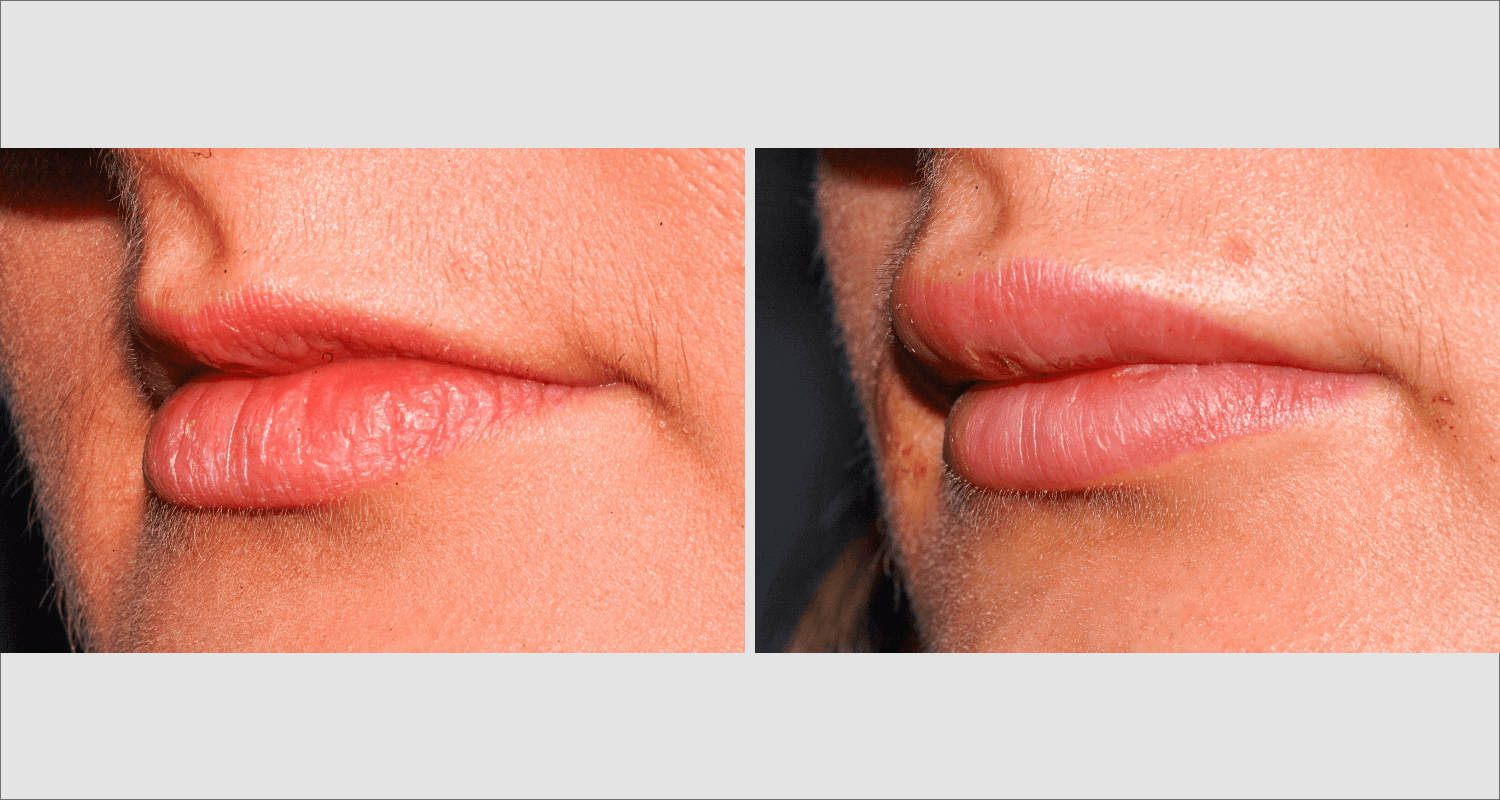 Vorher/Nachher Ergebnis: Eigenfett Lippen
