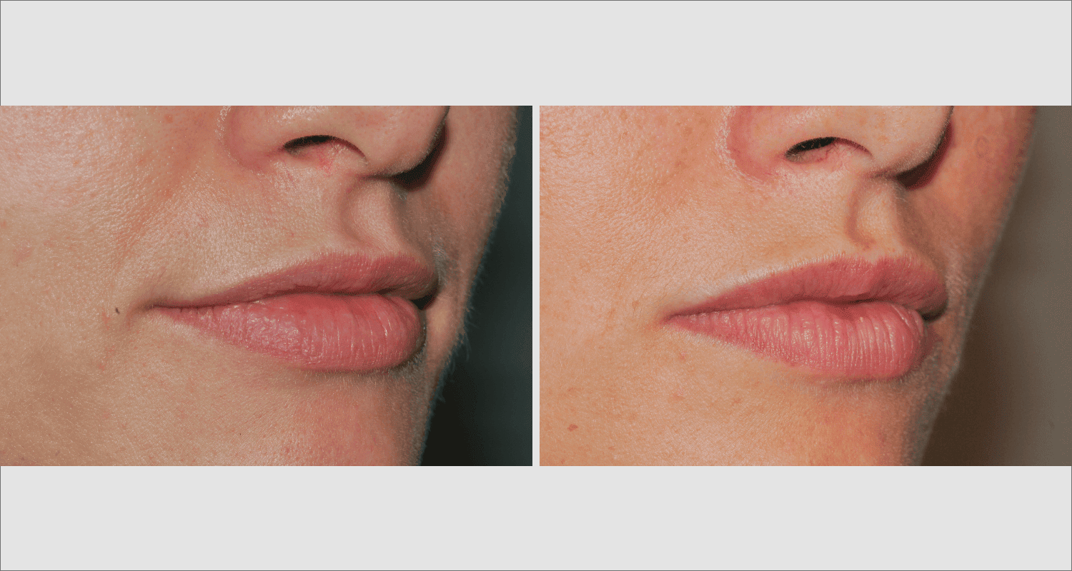 Vorher/Nachher Ergebnis: Eigenfett Lippen