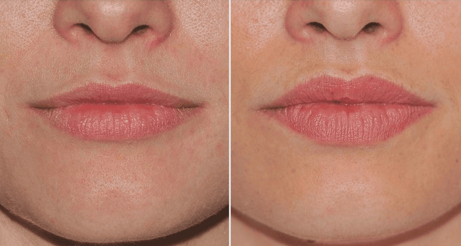 Vorher/Nachher Ergebnis: Eigenfett Lippen
