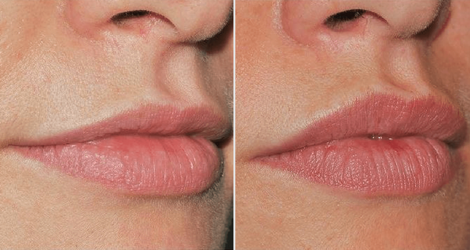 Vorher/Nachher Ergebnis: Eigenfett Lippen