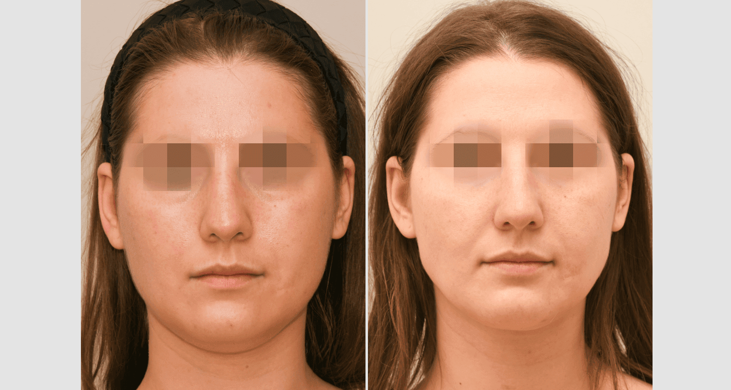 Vorher/Nachher Ergebnis: Eigenfett Schlaefen