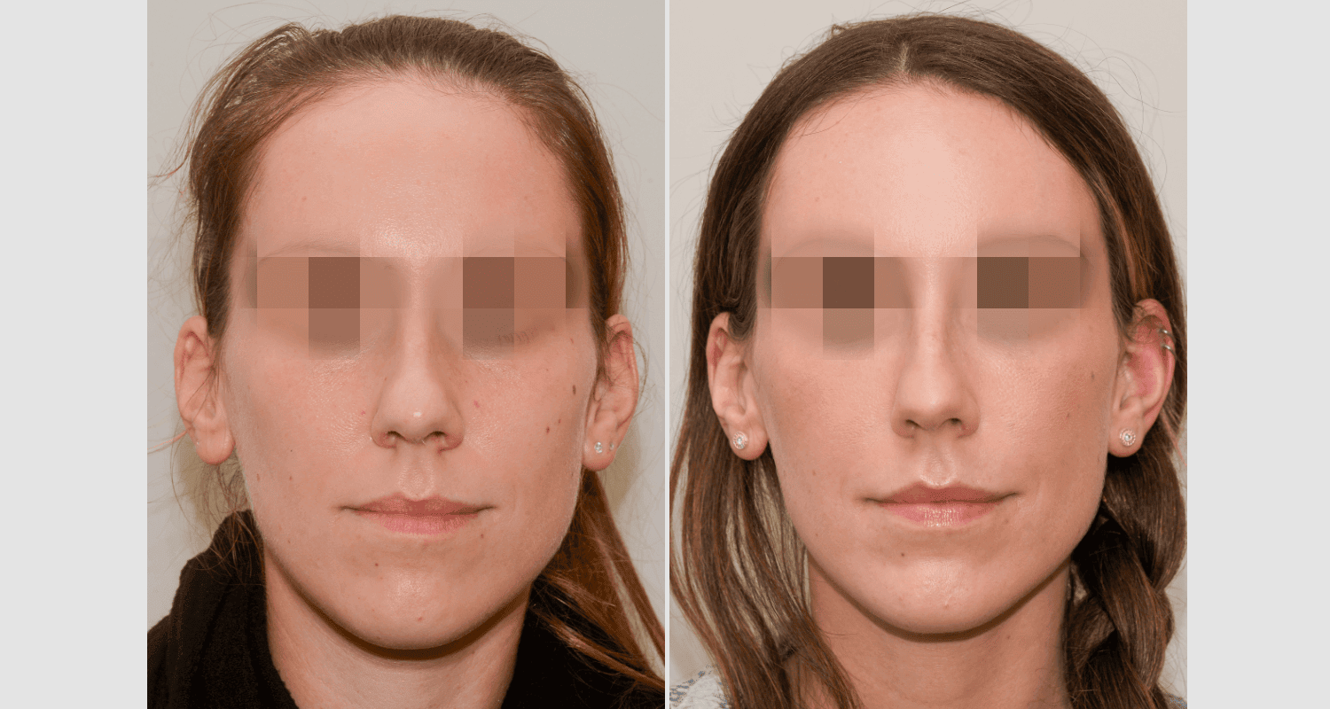 Vorher/Nachher Ergebnis: Eigenfett Schlaefen