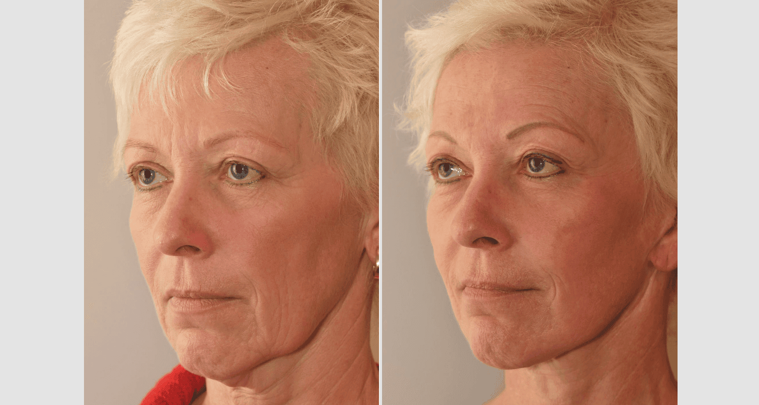 Vorher/Nachher Ergebnis: Facelift