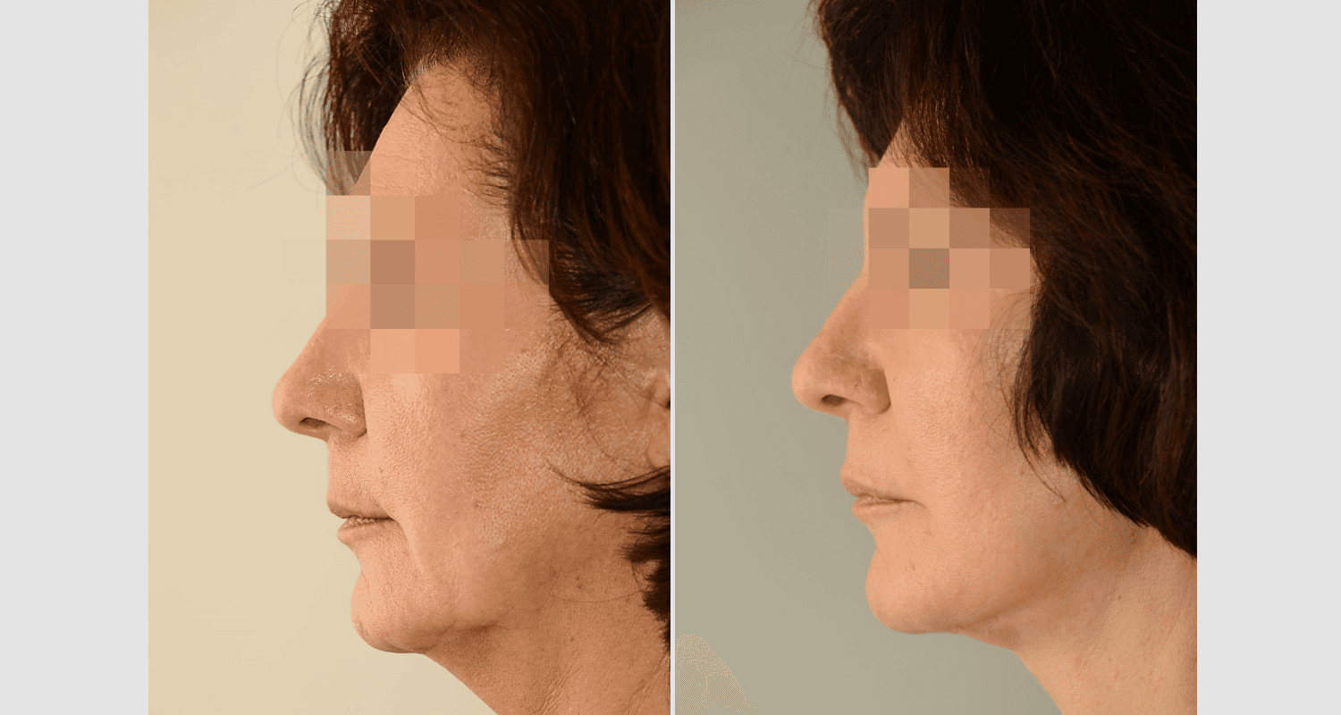 Vorher/Nachher Ergebnis: Facelift