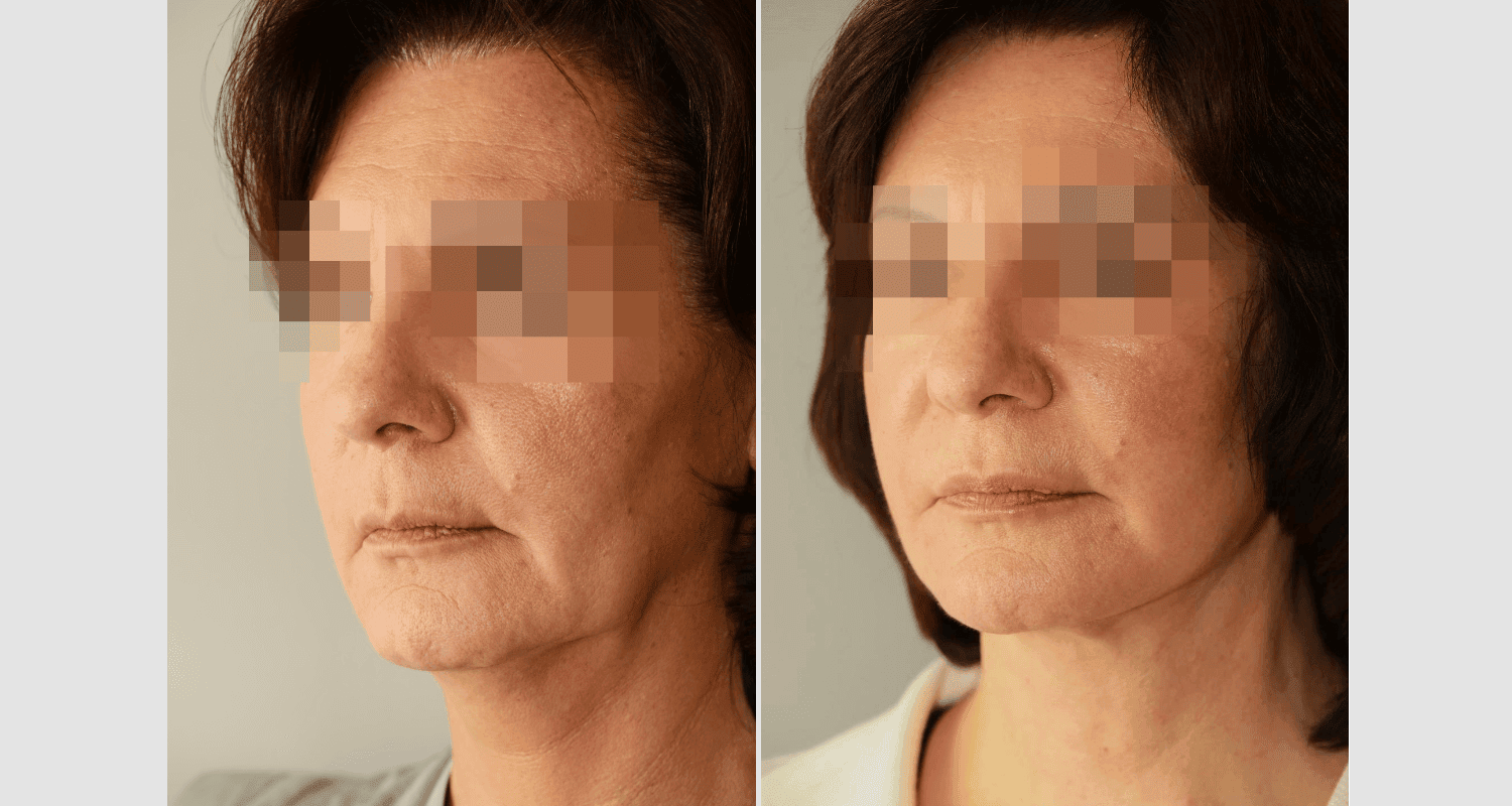 Vorher/Nachher Ergebnis: Facelift