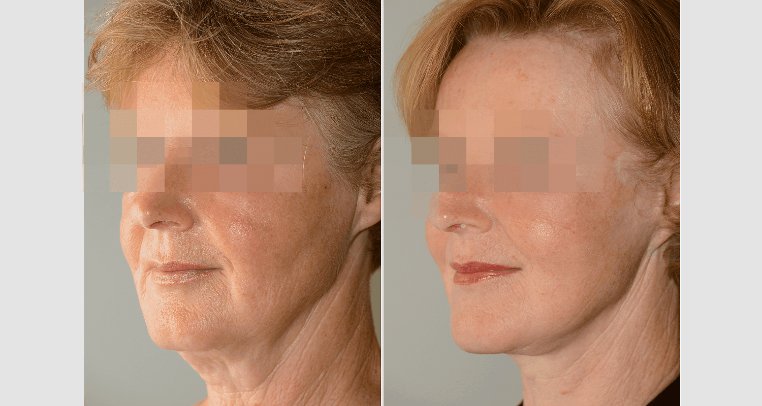 Vorher/Nachher Ergebnis: Facelift