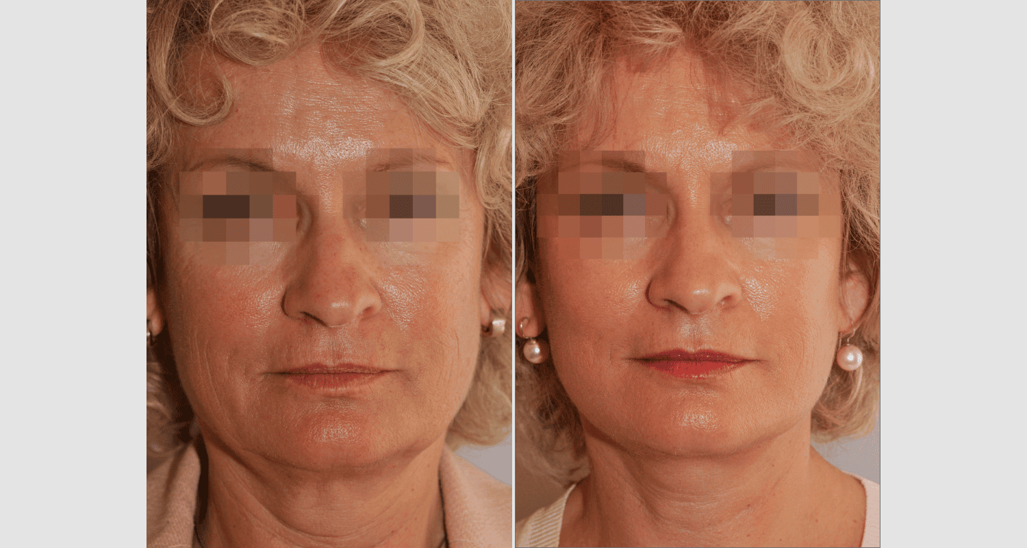 Vorher/Nachher Ergebnis: Facelift