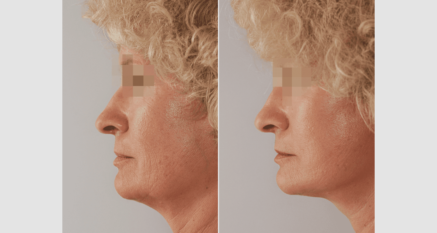 Vorher/Nachher Ergebnis: Facelift