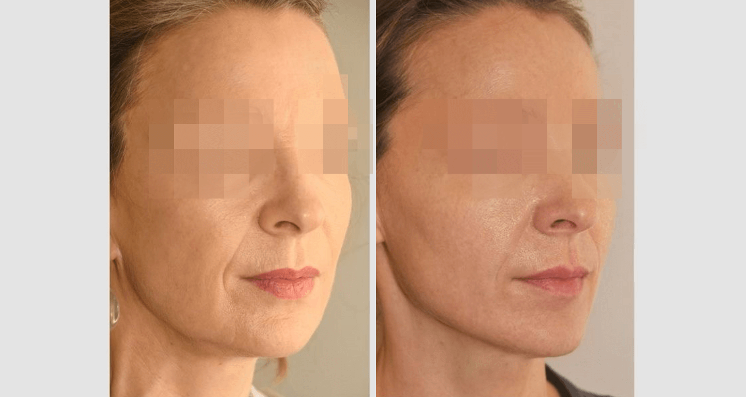 Vorher/Nachher Ergebnis: Facelift
