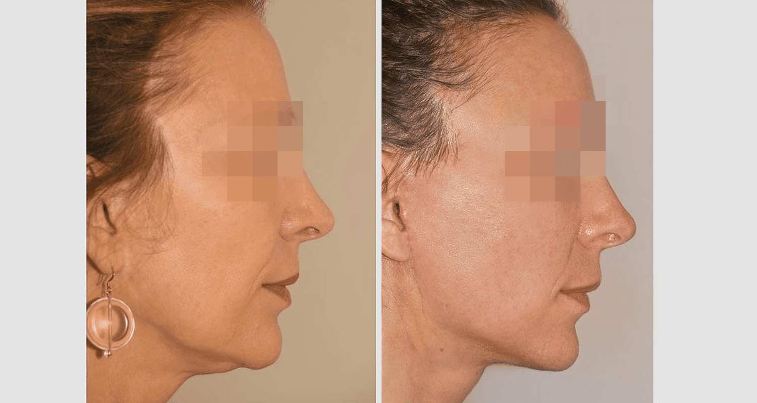 Vorher/Nachher Ergebnis: Facelift