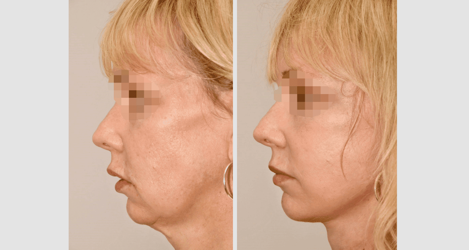 Vorher/Nachher Ergebnis: Facelift