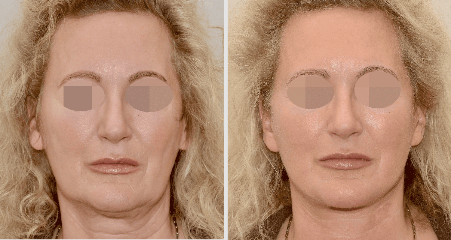 Vorher/Nachher Ergebnis: Facelift