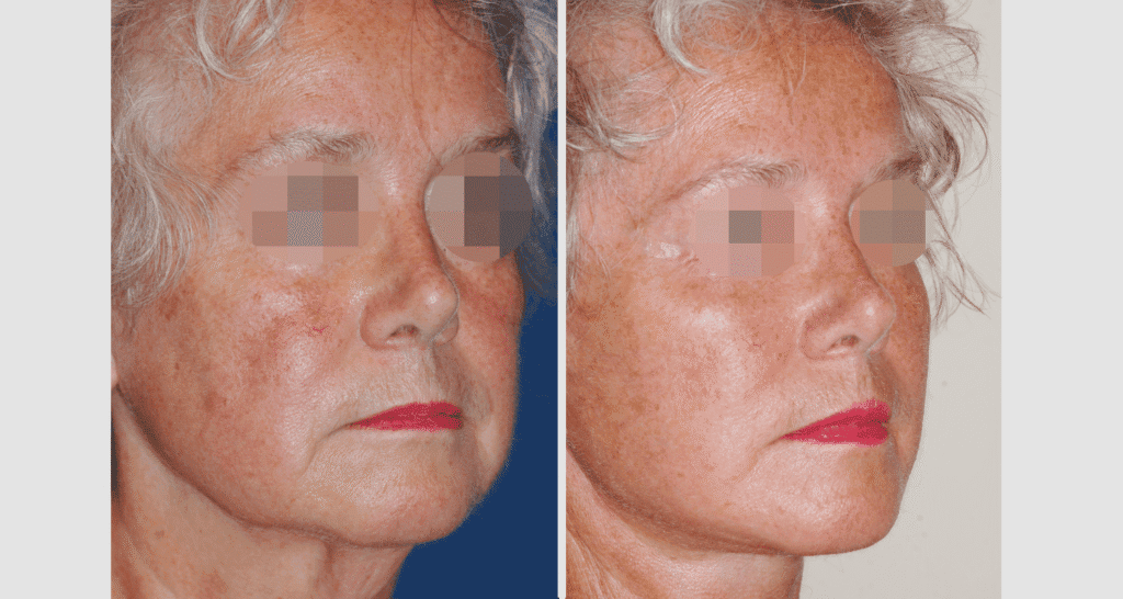 Vorher/Nachher Ergebnis: Facelift