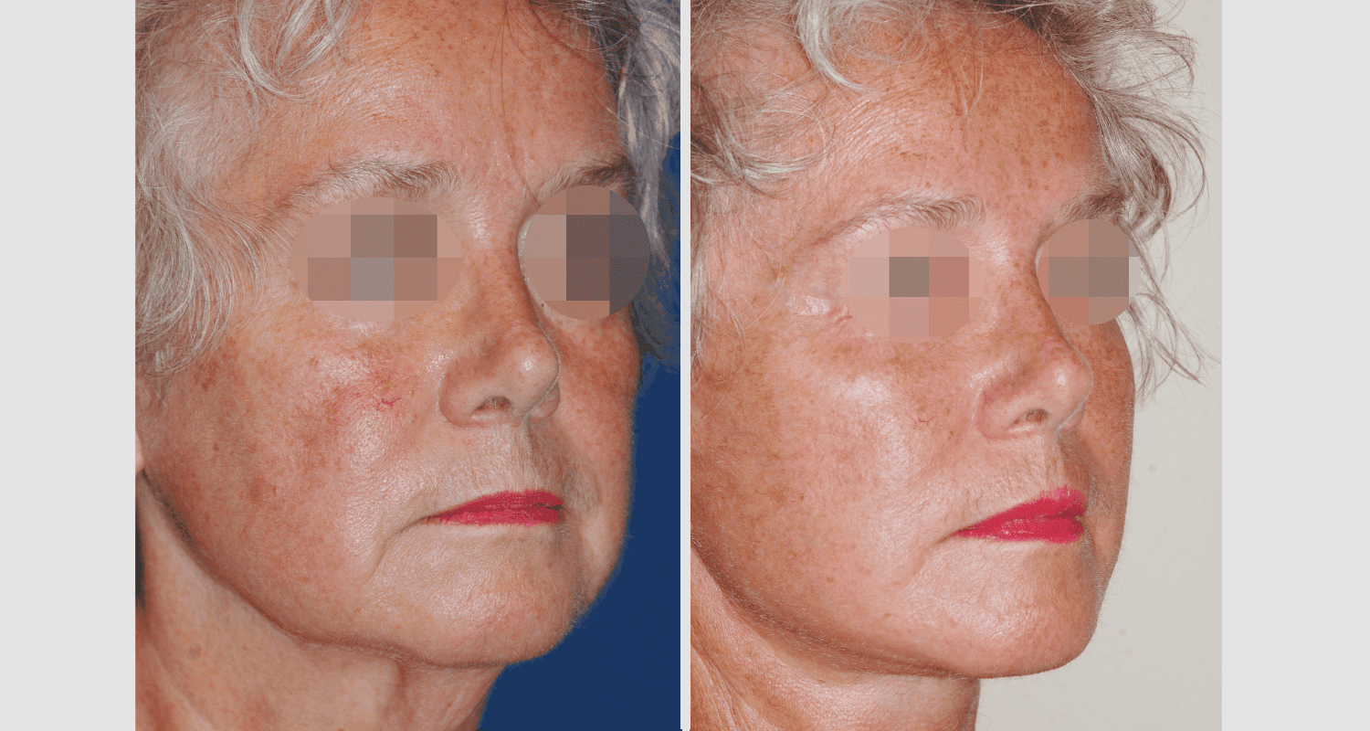 Vorher/Nachher Ergebnis: Facelift
