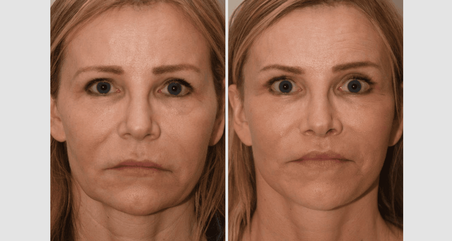 Vorher/Nachher Ergebnis: Facelift