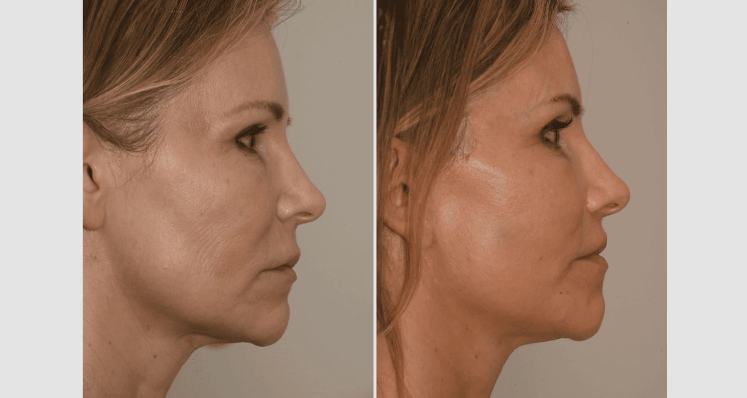 Vorher/Nachher Ergebnis: Facelift