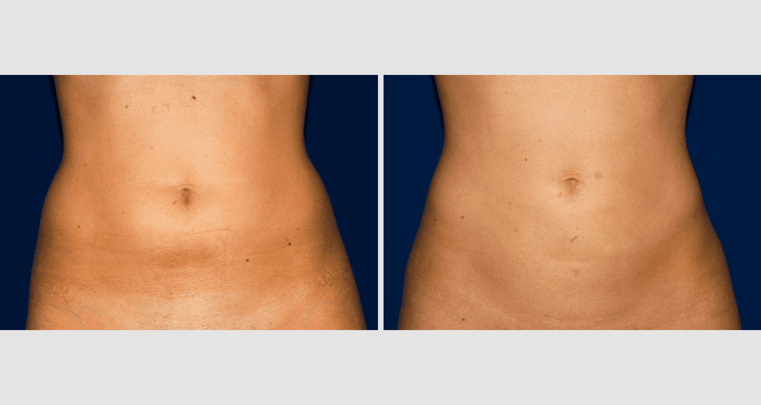 Vorher/Nachher Ergebnis: Fettabsaugung Bauch Huefte