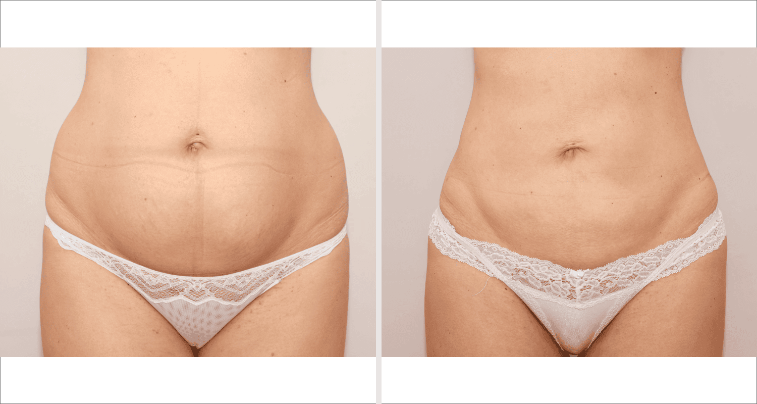 Vorher/Nachher Ergebnis: Fettabsaugung Bauch Huefte