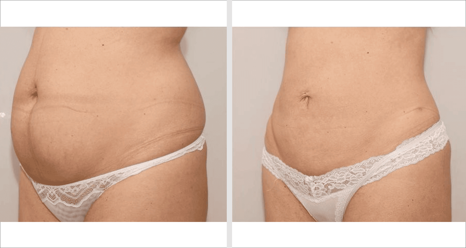Vorher/Nachher Ergebnis: Fettabsaugung Bauch Huefte
