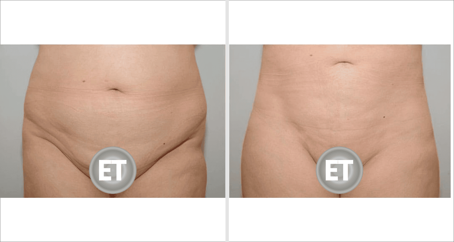 Vorher/Nachher Ergebnis: Fettabsaugung Bauch Huefte