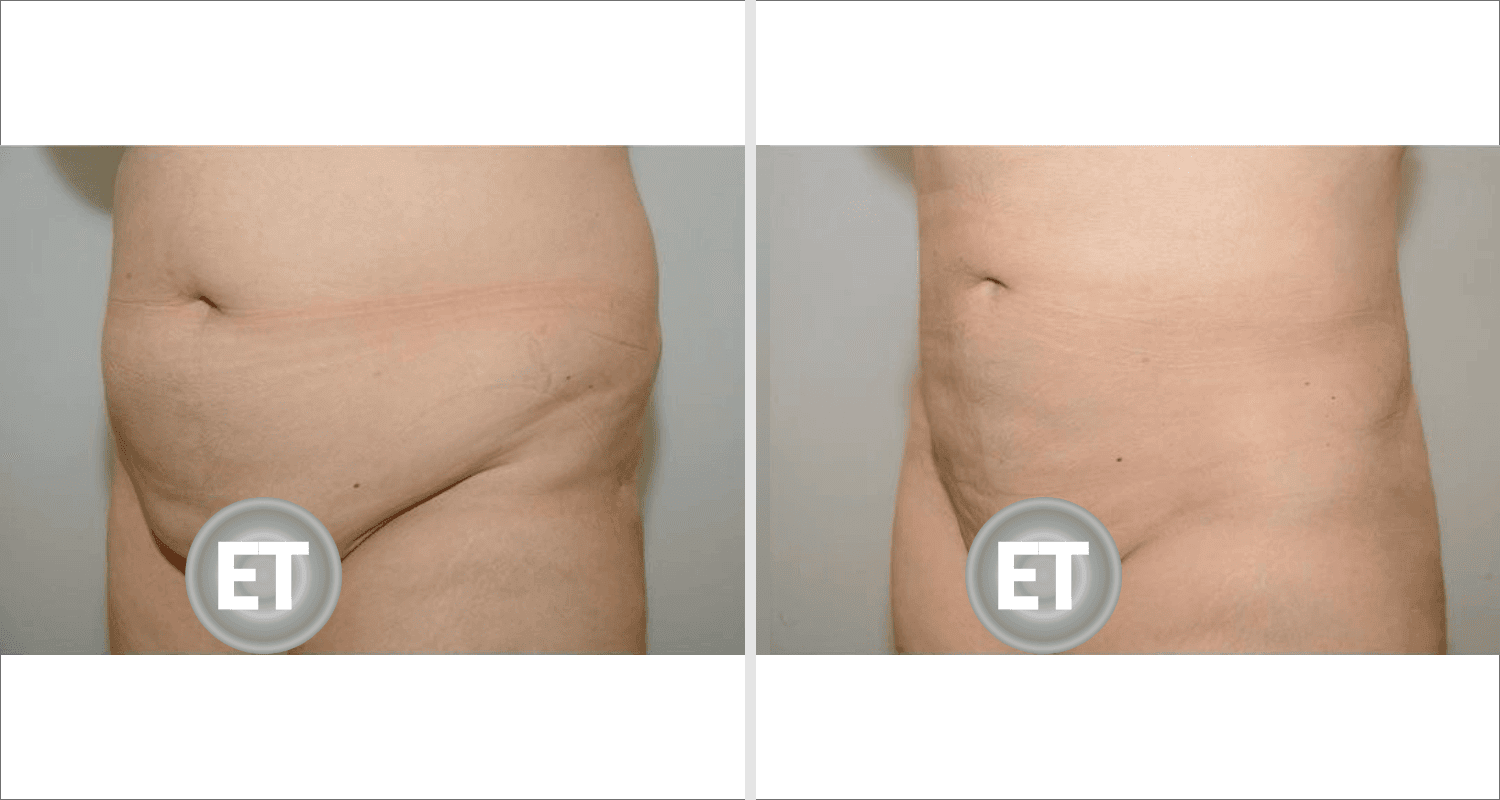 Abdomen liposuction results showing reduction of fat and improved contour.