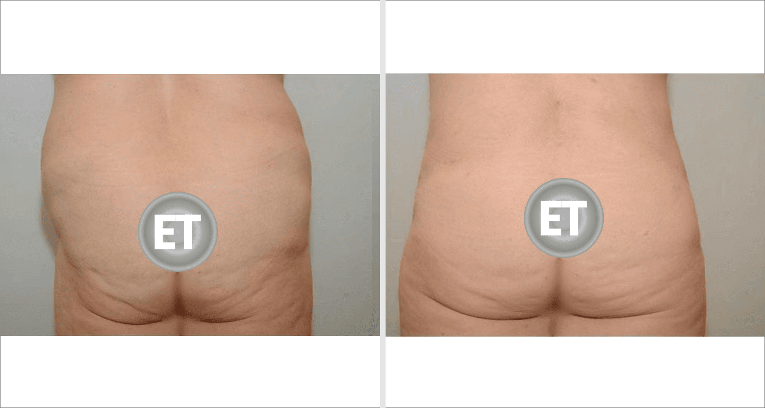 Vorher/Nachher Ergebnis: Fettabsaugung Bauch Huefte