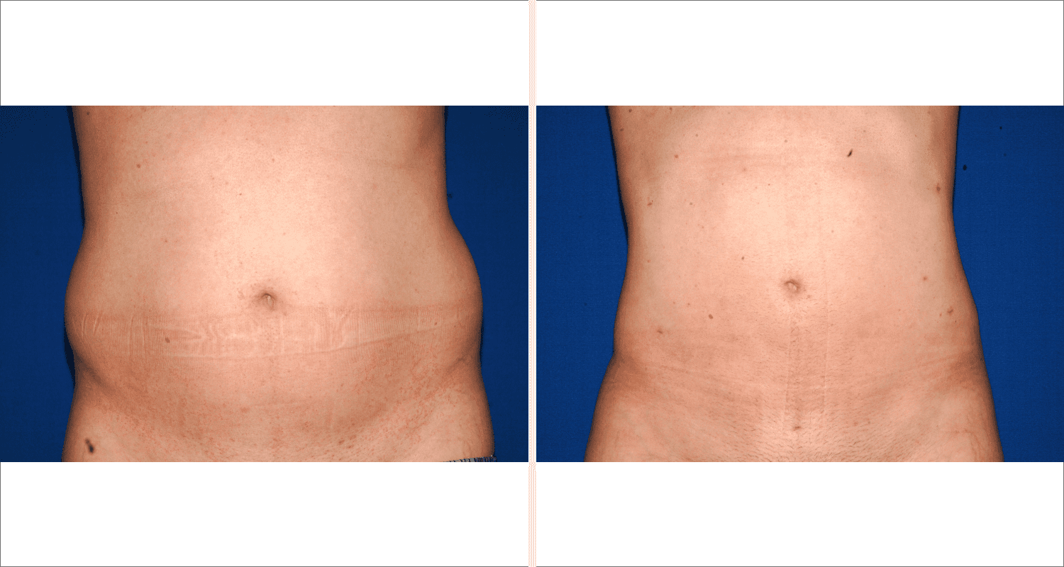 Vorher/Nachher Ergebnis: Fettabsaugung Bauch Huefte
