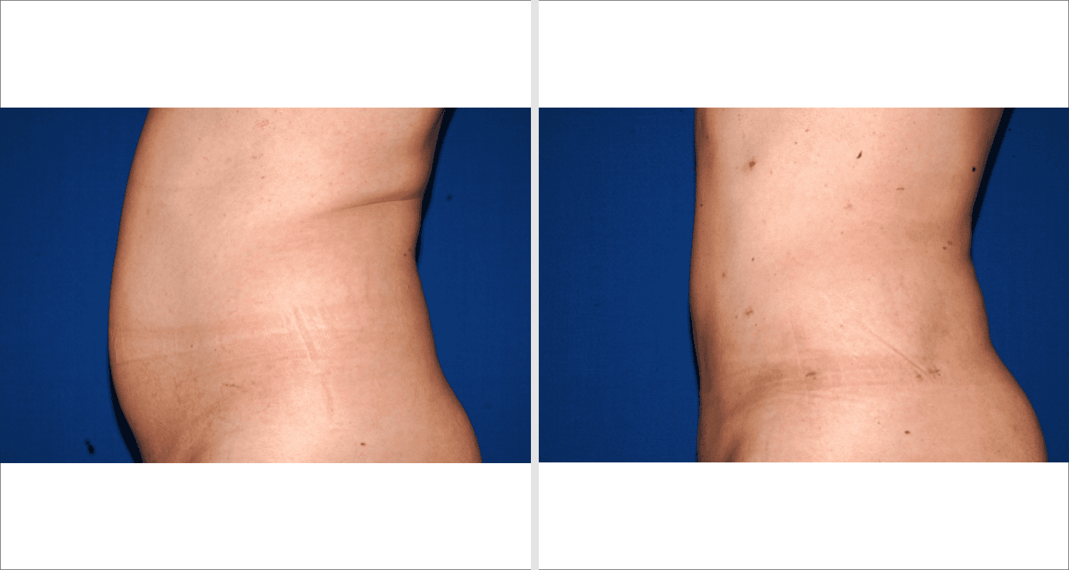 Vorher/Nachher Ergebnis: Fettabsaugung Bauch Huefte