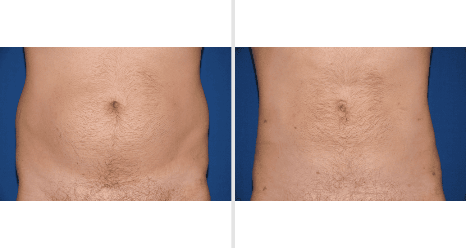 Vorher/Nachher Ergebnis: Fettabsaugung Bauch Huefte