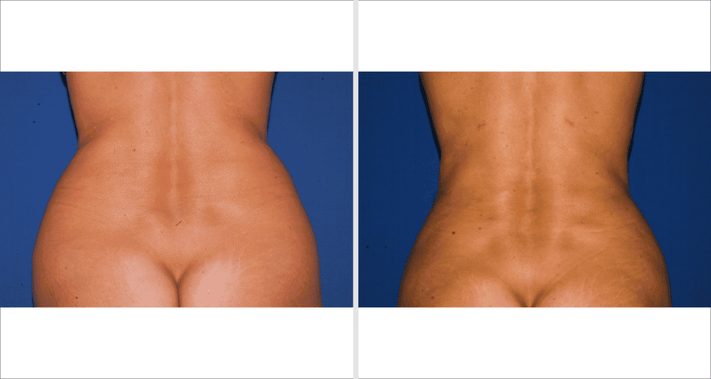 Vorher/Nachher Ergebnis: Fettabsaugung Bauch Huefte