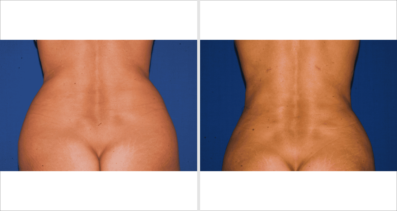 Vorher/Nachher Ergebnis: Fettabsaugung Bauch Huefte