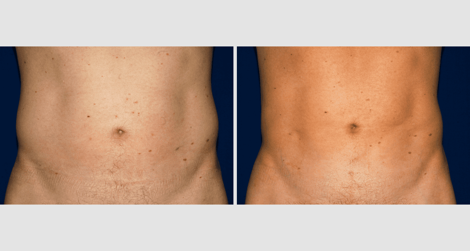 Vorher/Nachher Ergebnis: Fettabsaugung Bauch Huefte