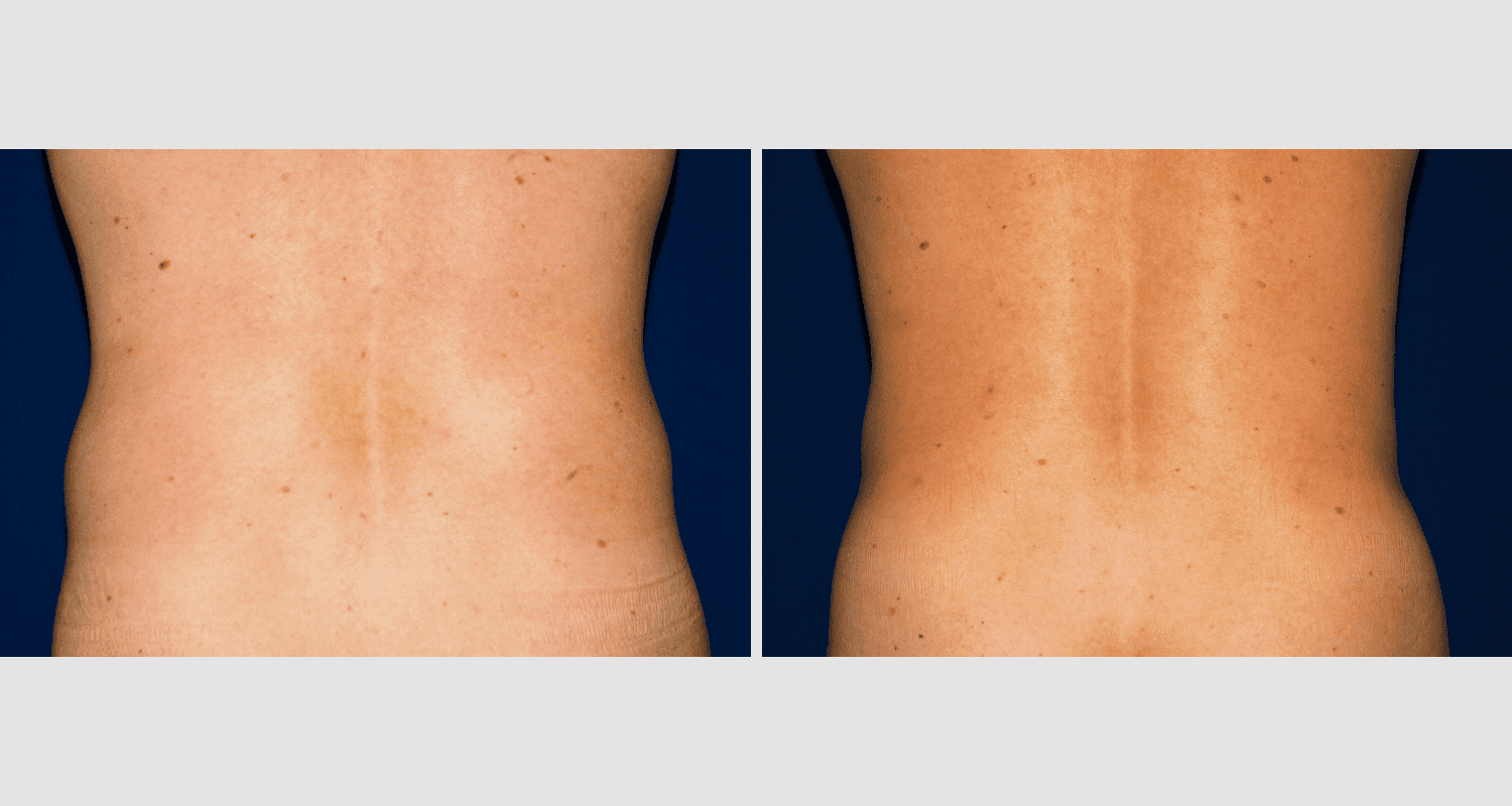 Vorher/Nachher Ergebnis: Fettabsaugung Bauch Huefte