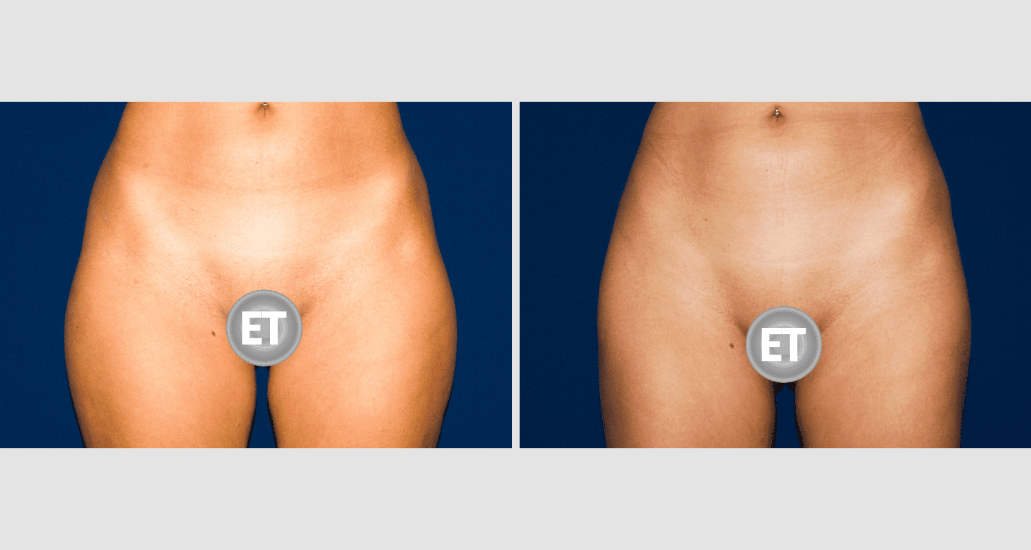 Vorher/Nachher Ergebnis: Fettabsaugung Bauch Huefte