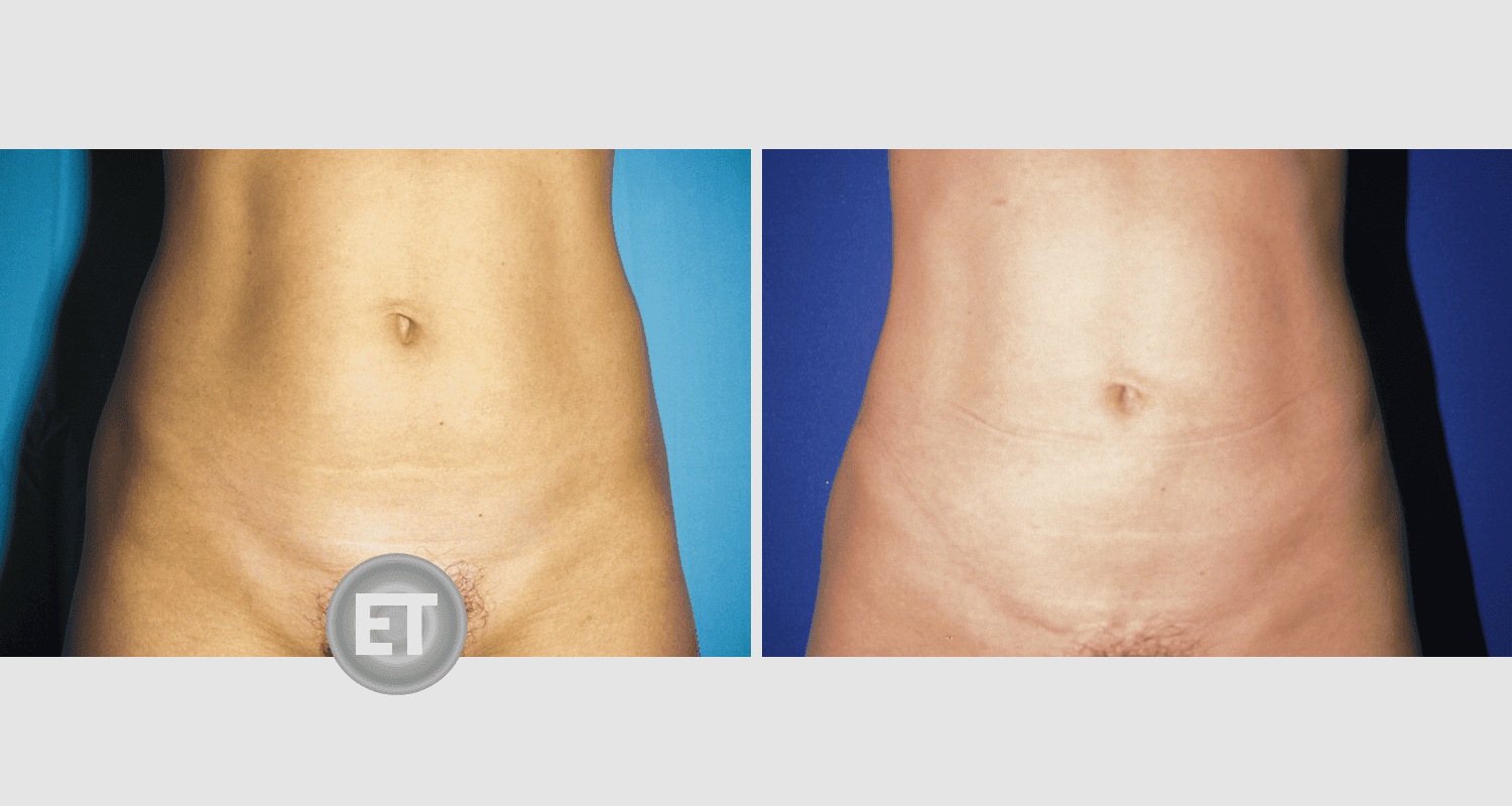 Vorher/Nachher Ergebnis: Fettabsaugung Bauch Huefte