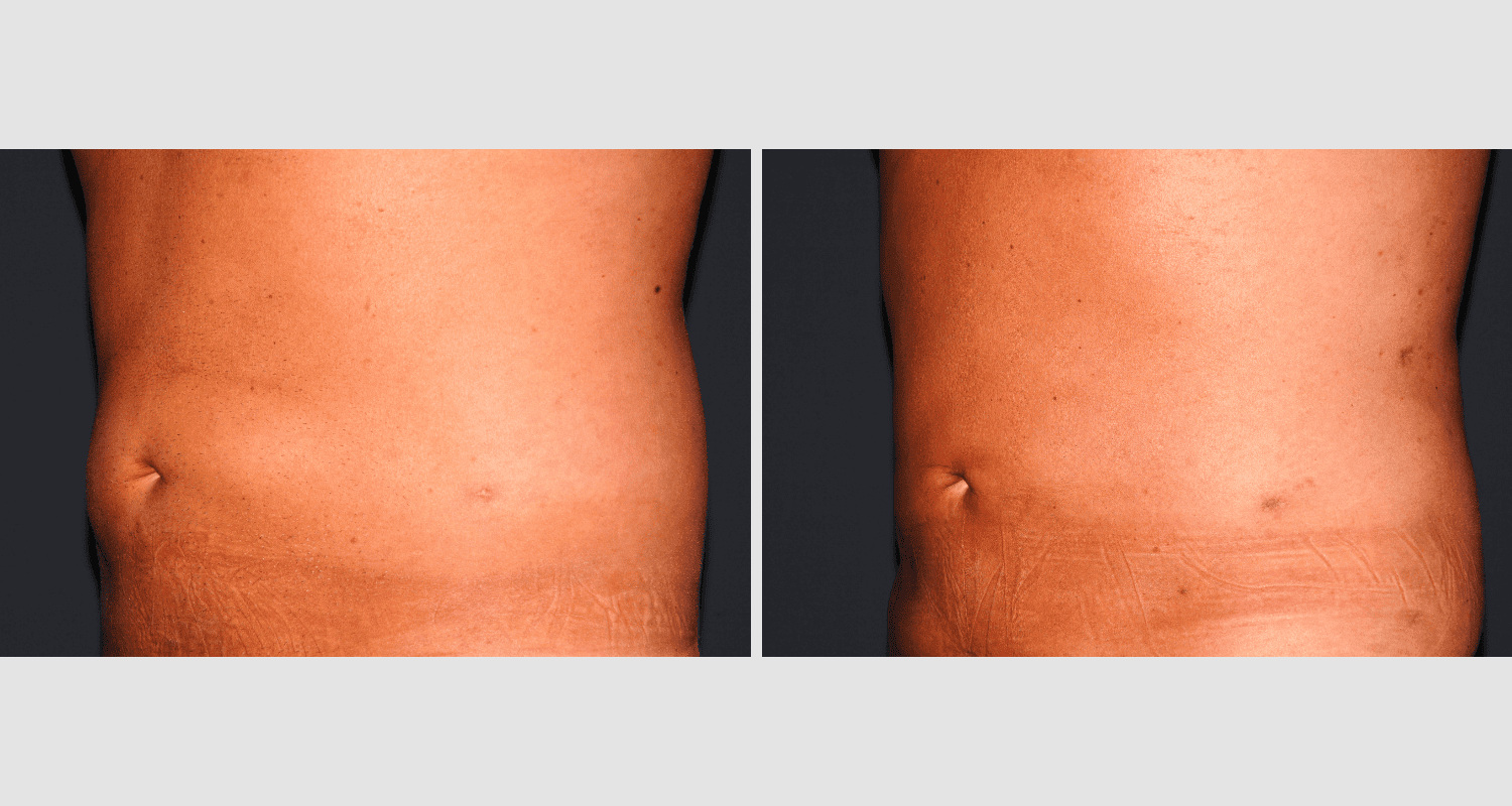 Vorher/Nachher Ergebnis: Fettabsaugung Bauch Huefte