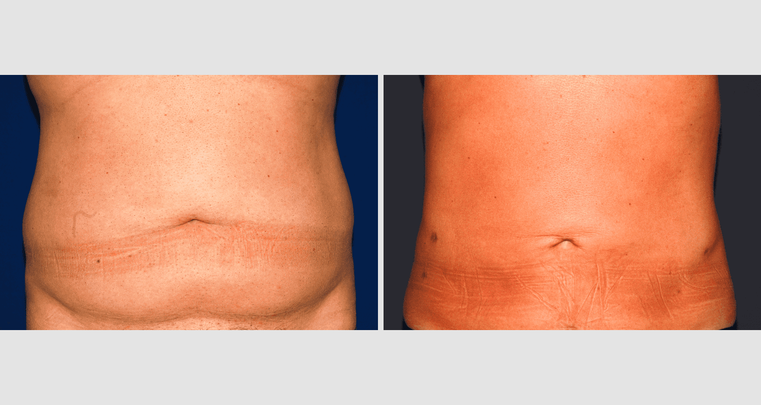 Vorher/Nachher Ergebnis: Fettabsaugung Bauch Huefte