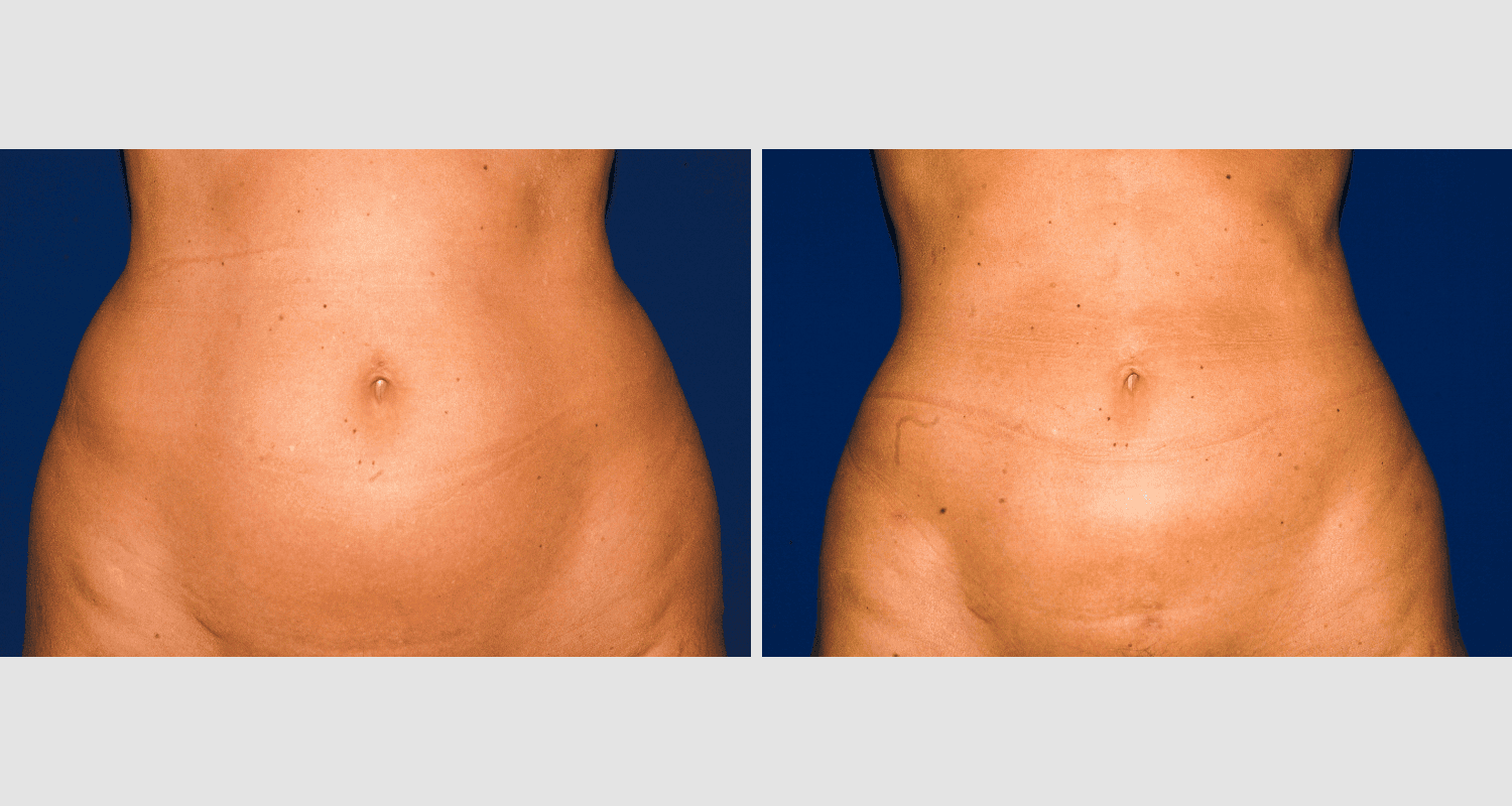 Vorher/Nachher Ergebnis: Fettabsaugung Bauch Huefte