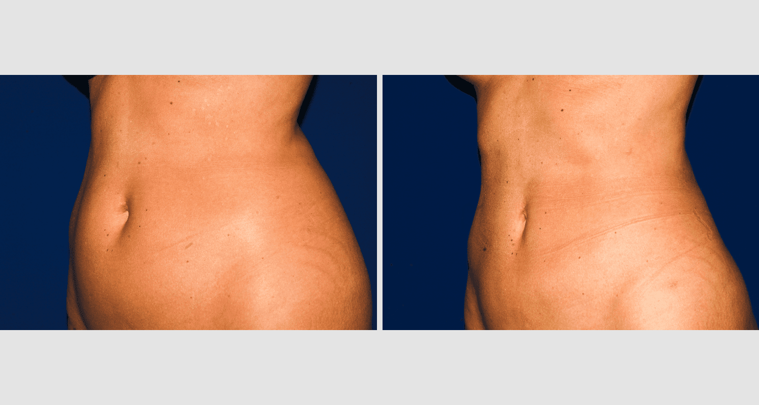 Vorher/Nachher Ergebnis: Fettabsaugung Bauch Huefte