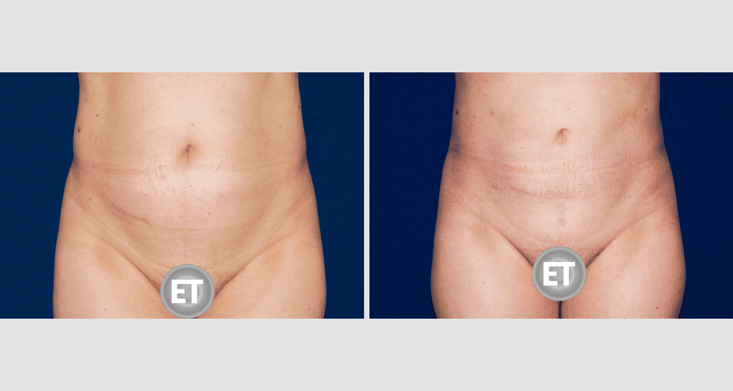 Vorher/Nachher Ergebnis: Fettabsaugung Bauch Huefte