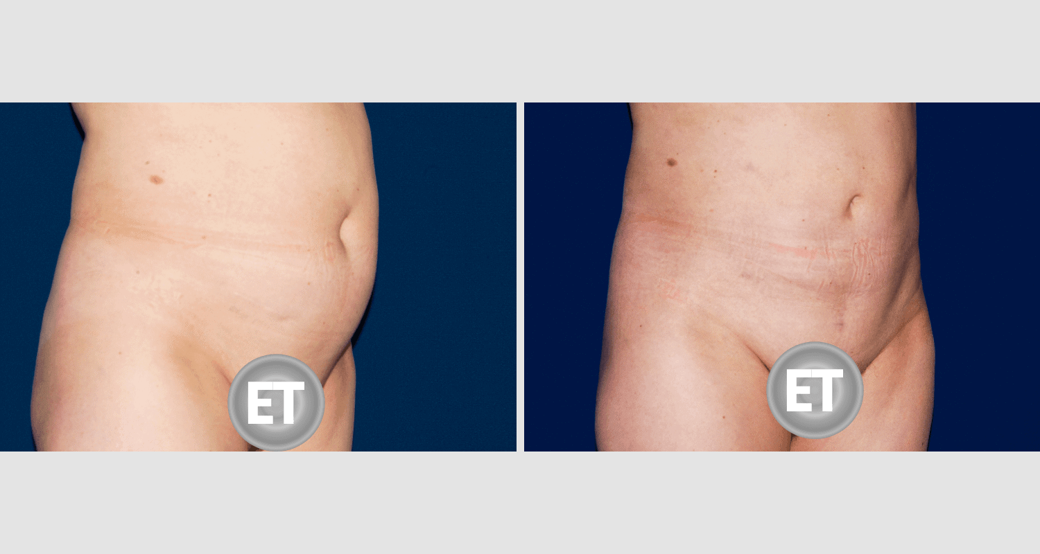 Vorher/Nachher Ergebnis: Fettabsaugung Bauch Huefte