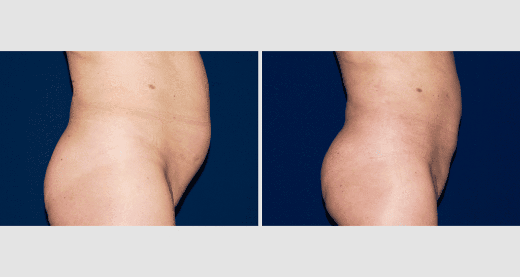 Vorher/Nachher Ergebnis: Fettabsaugung Bauch Huefte
