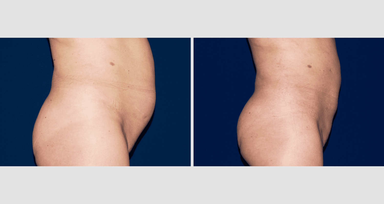 Vorher/Nachher Ergebnis: Fettabsaugung Bauch Huefte