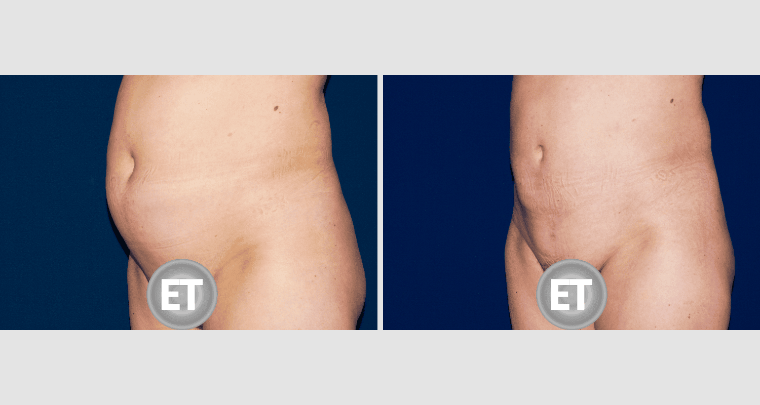 Vorher/Nachher Ergebnis: Fettabsaugung Bauch Huefte