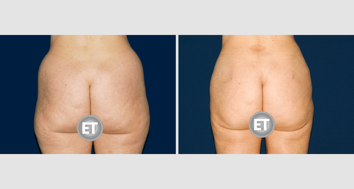 Vorher/Nachher Ergebnis: Fettabsaugung Bauch Huefte
