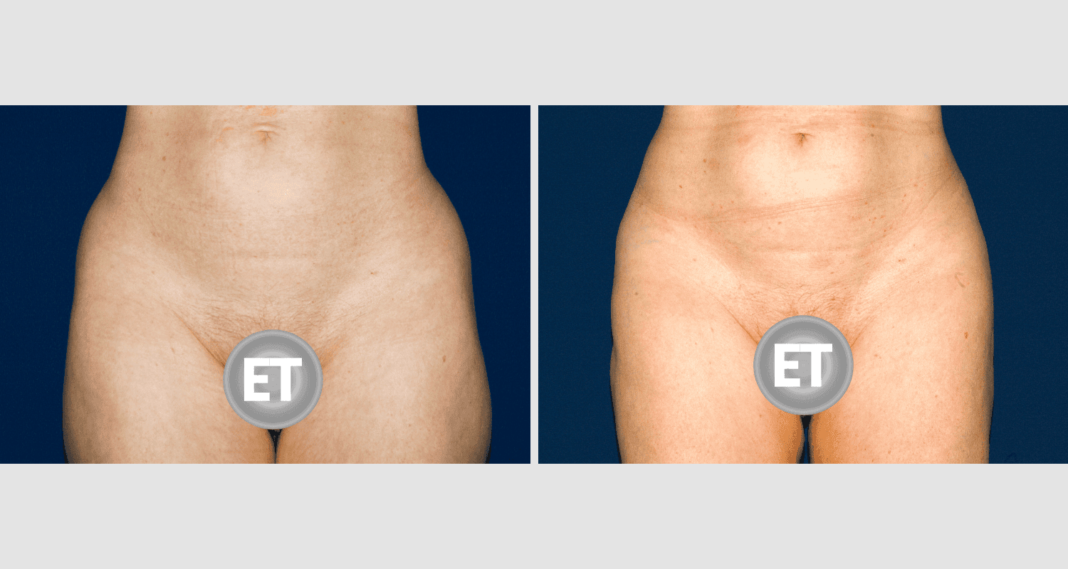 Vorher/Nachher Ergebnis: Fettabsaugung Bauch Huefte