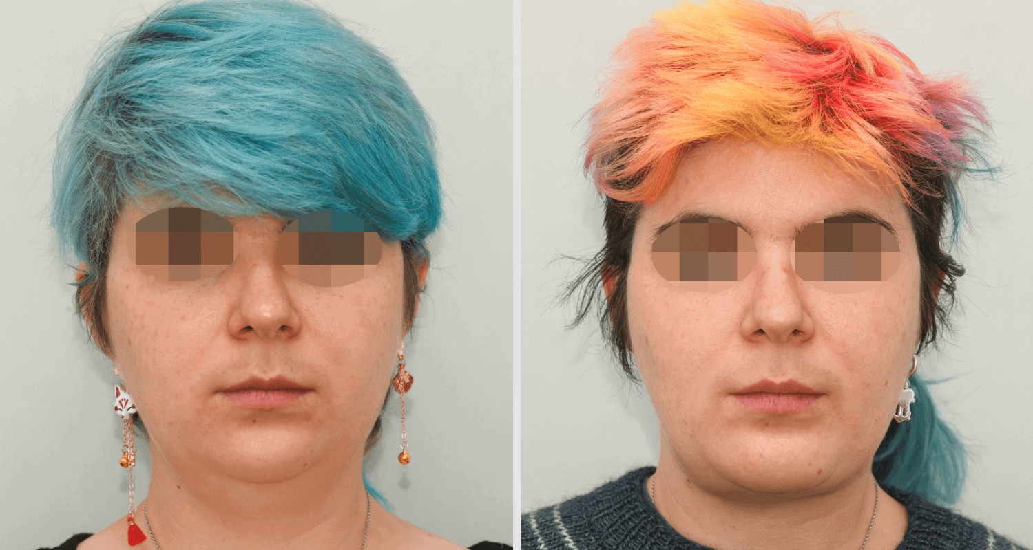 Vorher/Nachher Ergebnis: Kinnkorrektur Vergroesserung