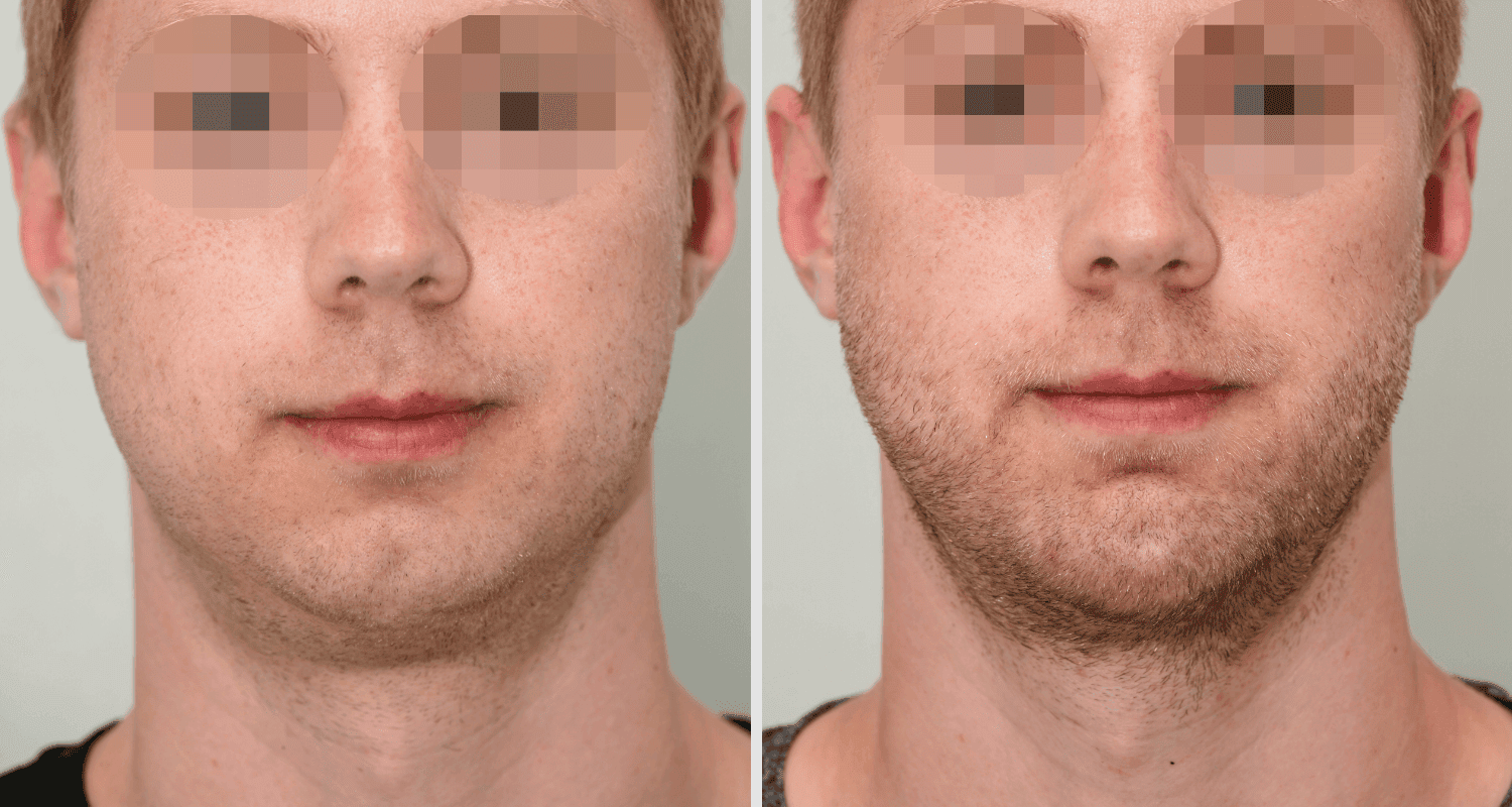 Vorher/Nachher Ergebnis: Kinnkorrektur Vergroesserung