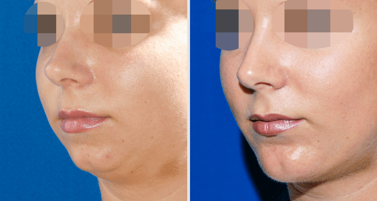 Vorher/Nachher Ergebnis: Kinnkorrektur Vergroesserung